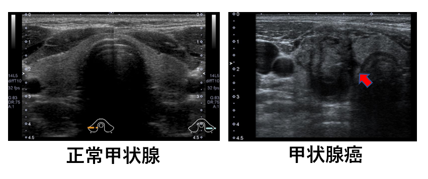 甲状腺超音波検査