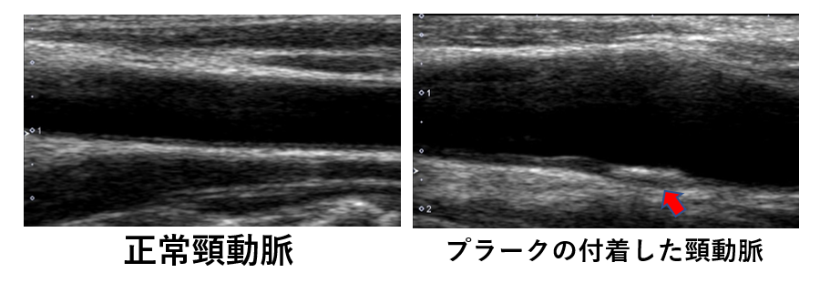 頸動脈・下肢静脈瘤超音波検査