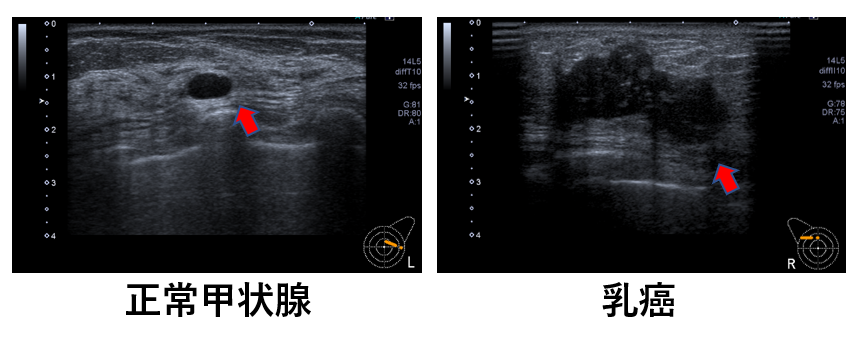 乳腺超音波検査